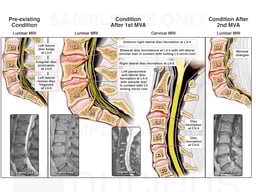 Progression of Lumbar Spine Injuries: Before MVA, after 1st MVA and 2nd MVA