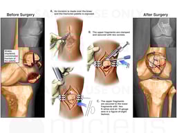 Left Patellar Fracture with Surgical Fixation