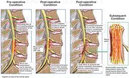 Progression of Lumbar Condition