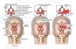 Rupture of Cerebral Artery Aneurysm