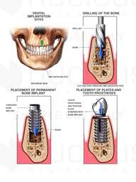 Dental Implant Procedure
