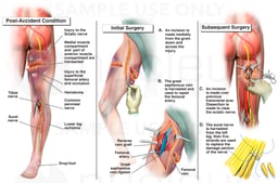 Right Thigh Crush Injury and Sciatic Nerve Damage with Surgical Nerve Graft Repair
