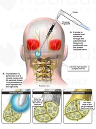 Cryoablation of Greater Occipital Nerves