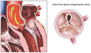 Damaged Aortic Valve