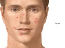 Acne