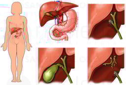 Correct vs. Incorrect Cholecystectomy (Gallbladder Removal) Procedure