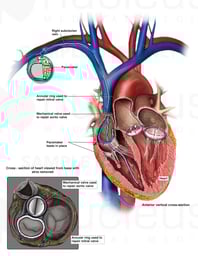 Multiple Heart Surgeries