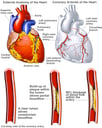 Heart - Coronary Arteries with Potential Blockages
