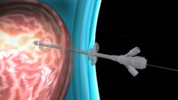 Percutaneous Endoscopic Gastrostomy (PEG) Feeding Tube