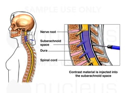 Placement of Subarachnoid Contrast Material