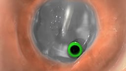 Tympanostomy Tube in Tympanic Membrane