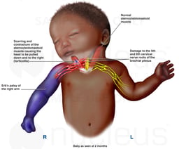 Shoulder Dystocia and Brachial Plexus Injury