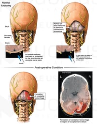 Cerebellar Hemorrhage Following Occipital Nerve Block Injection