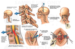 Displaced Fracture-Dislocation at C5-C6 with Cervical Fusion