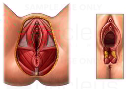 Third Degree Episiotomy Tear