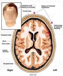 Brain Injury - Subdural Hematoma