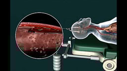 Tearing of the Vertebral Artery Wall and Resulting Stroke