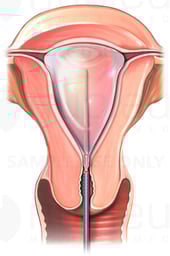 Thermal Endometrial Ablation Technique