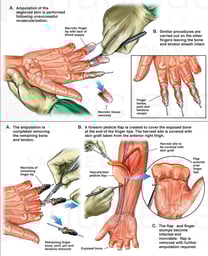 Second Through Fourth of Eight Attempts at Surgical Repair