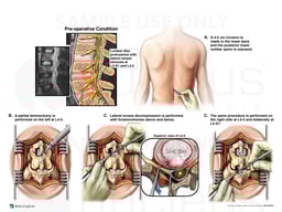 Lumbar Spine Injuries with Surgical Decompression