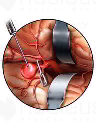 Withdraw Blood from Cerebral Aneurysm