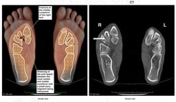 Right Foot Fracture