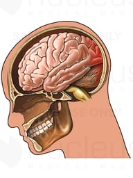 Traumatic Brain Injury - Whiplash Closed Head Injury