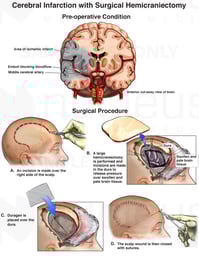 Cerebral Infarction with Surgical Hemicraniectomy