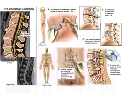 Lumbar Spine Injuries with Surgical Fusions
