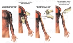 Electrocution Burn Injury of the Left Arm with Surgical Amputation