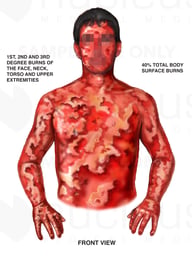 Male Torso with Post-accident Burn Injuries