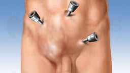 Inguinal Hernia Surgery - Laparascopic Repair