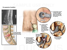 L4-5 Disc Herniation with Minimally Invasive Surgical Repair