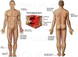 Second and Third Degree Burns
