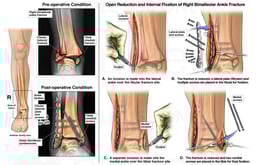 Right Ankle Fracture with Surgical Fixation
