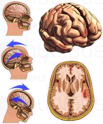 Whiplash - Closed Head Injury with Resulting Brain Injury