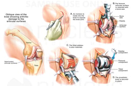 Total Left Knee Replacement Surgery