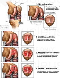 Patellofemoral Osteoarthritis of the Knee