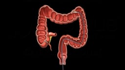 Looping of the Colonoscope - Medical Animation