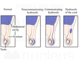 Hydrocele - Fluid-filled Cyst of the Groin