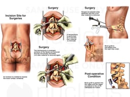 Various Lumbar Disc Surgeries