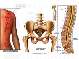 Injuries to the Back, Pelvis and Mid and Lower Spine