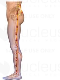 Radiating Pain through Leg - lateral view
