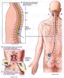 Spinal Cord Stimulator with Battery Pack