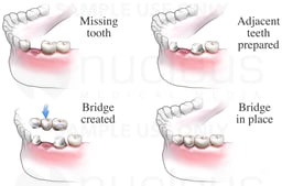 Dental Bridge