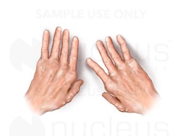 Rheumatoid Arthritis Seen in the Hands