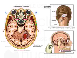 Right Cerebellar Hemorrhage with Proposed Surgical Treatment