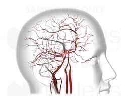 Occlusion Cerebral Arteries / Stroke