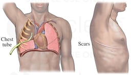 Post-operative Lobectomy