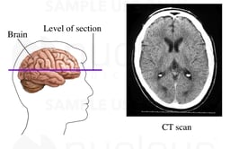 CT Scan of Head